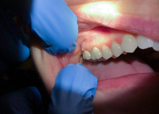 Best Chipped Tooth Repair Near Me  in Grain Valley, MO
